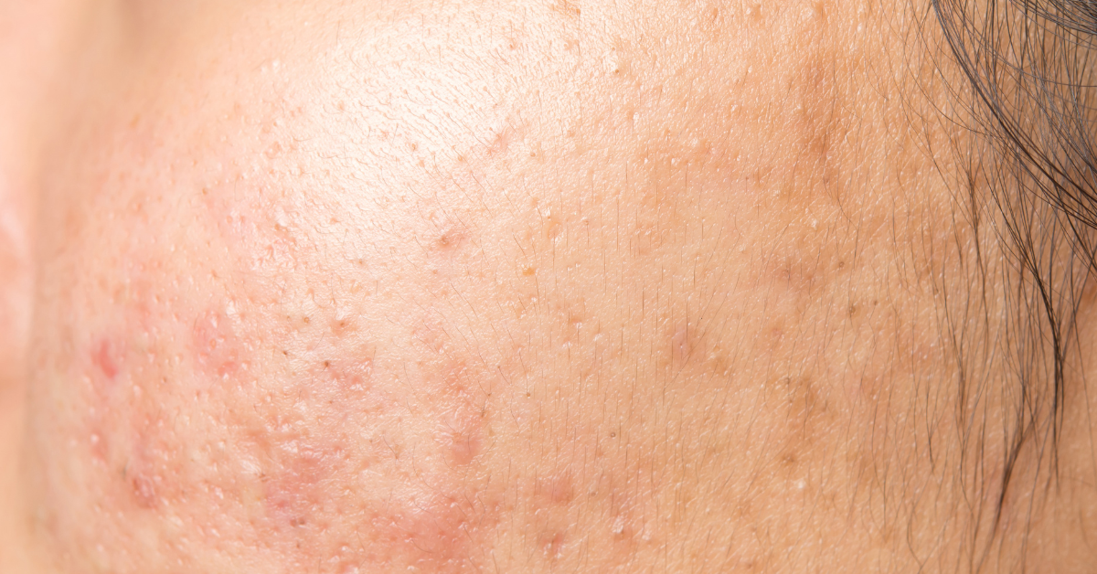 Learn More About The Link Between Nicotine And Acne Fitness Talk